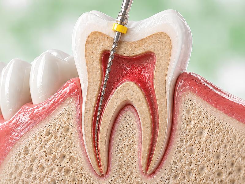 Wurzelkanalbehandlung und Endodontologie