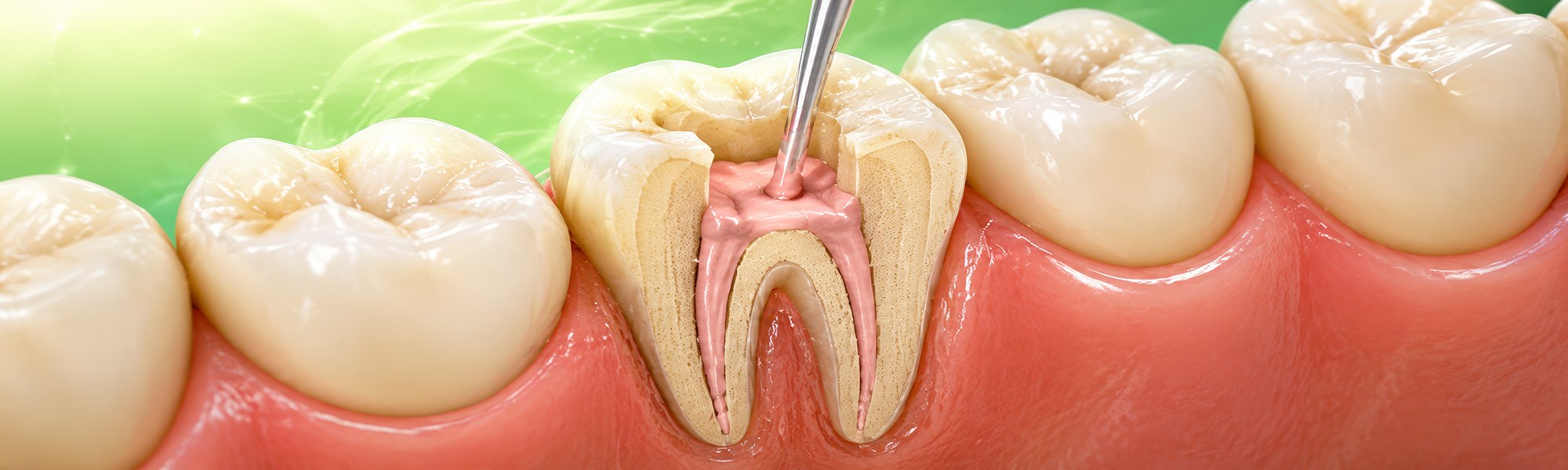 Endodontische Instrumente zur Reinigung und Aufbereitung von Wurzelkanälen