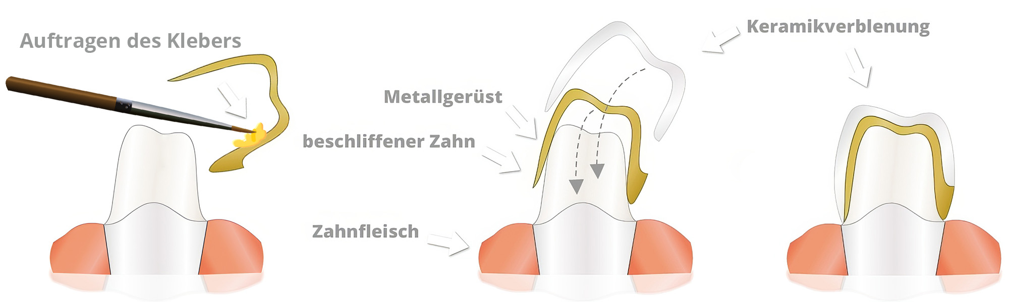 Schematische Darstellung des Einsetzens einer Vollgusskrone: Befestigungsmaterial wird aufgetragen, die Metallkrone auf den beschliffenen Zahn gesetzt und fest eingegliedert.
